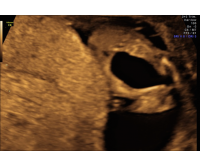 Luto keyhole bladder
